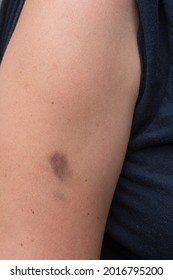 Hematoma, Hematomas En El Brazo Femenino, Foto De Stock 2016795200 ...