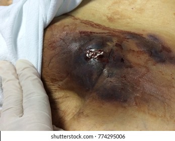 Hematoma and Infected wound,Human tissue skin with sepsis.
