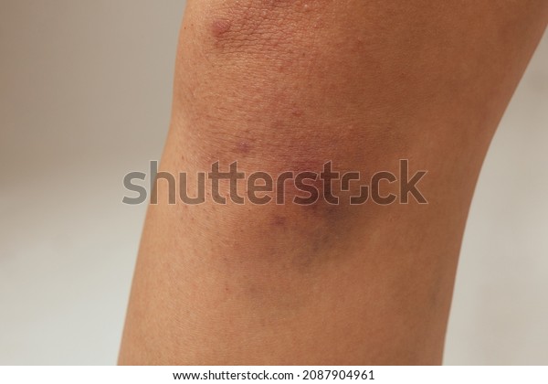 Blood Under The Skin Immagini Foto Stock E Grafica Vettoriale Shutterstock