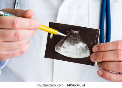 Hematoma Of Spleen On Ultrasound Image Concept Photo. Doctor Indicating By Pen On Printed Picture Ultrasound Pathology -  Splenic Hematoma. Photo For Diagnosis, Radiology, Surgery, Traumatology