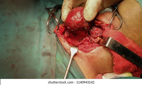 Hemithyroidectomy specimen of thyroid gland with exposed recurrent laryngeal nerve being identified and preserved duting surgery.