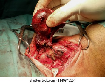 Hemithyroidectomy specimen of thyroid gland with exposed recurrent laryngeal nerve being identified and preserved duting surgery.