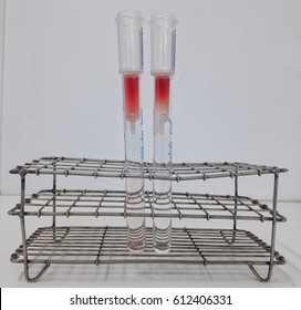 Hemoglobin E Screening test by eluded from the column  present positive HbE (left) and Negative HbE (right) 