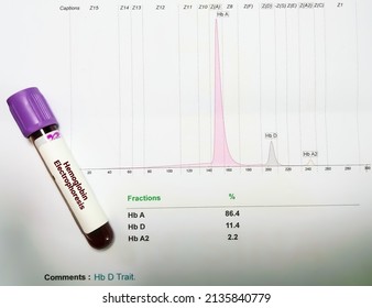 Hemoglobin Electrophoresis Report Blood Sample Showing Stock Fotografie   Hemoglobin Electrophoresis Report Blood Sample 260nw 2135840779 