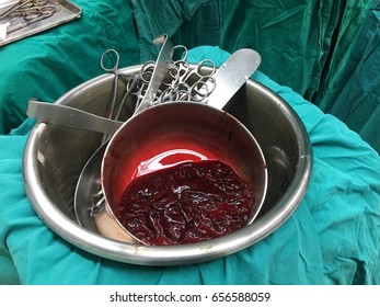 Hemoperitoneum Blood Clot Remove From Intra Abdominal Cavity In Rupture Ectopic Pregnancy Patient