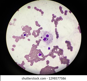 Hemophagocytosis In Bone Marrow Examination. 
Hemophagocytic Lymphohistiocytosis (HLH) Is A Potentially Fatal Disease Characterized By Abnormal Activation Of T-lymphocytes And Macrophages.