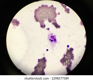 Hemophagocytosis In Bone Marrow Examination. 
Hemophagocytic Lymphohistiocytosis (HLH) Is A Potentially Fatal Disease Characterized By Abnormal Activation Of T-lymphocytes And Macrophages.