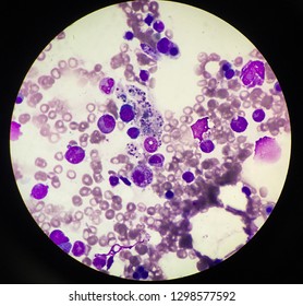 Hemophagocytosis In Bone Marrow Examination. 
Hemophagocytic Lymphohistiocytosis (HLH) Is A Potentially Fatal Disease Characterized By Abnormal Activation Of T-lymphocytes And Macrophages.