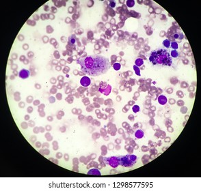 Hemophagocytosis In Bone Marrow Examination. 
Hemophagocytic Lymphohistiocytosis (HLH) Is A Potentially Fatal Disease Characterized By Abnormal Activation Of T-lymphocytes And Macrophages.