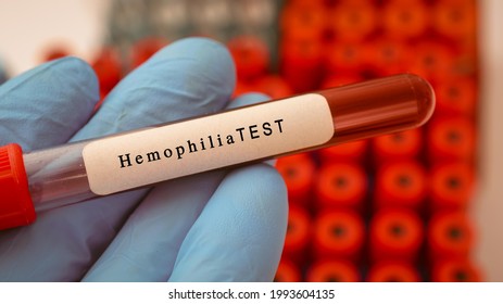 Hemophilia Test Result With Blood Sample In Test Tube On Doctor Hand In Medical Lab