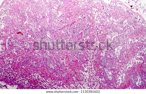 Hemorrhagic Lymphadenitits Lymph Node Inflammation Hemorrhage Stock ...