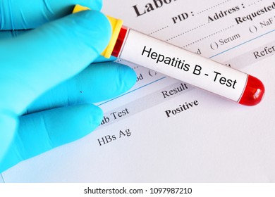 Hepatitis B Virus Positive Test Result Stock Photo 1097987210 ...