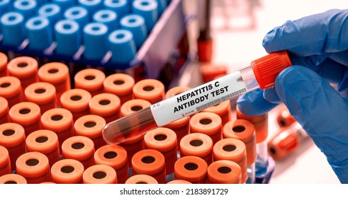 Hepatitis C Antibody Test Tube With Blood Sample In Infection Lab