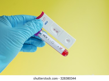 Hepatitis C Virus (HCV) Testing By Using Test Cassette, The Result Showed Positive (double Red Line)
