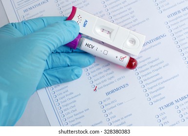 Hepatitis C Virus (HCV) Testing By Using Test Cassette, The Result Showed Positive (double Red Line)
