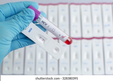 Hepatitis C Virus (HCV) Testing By Using Test Cassette, The Result Showed Positive (double Red Line)
