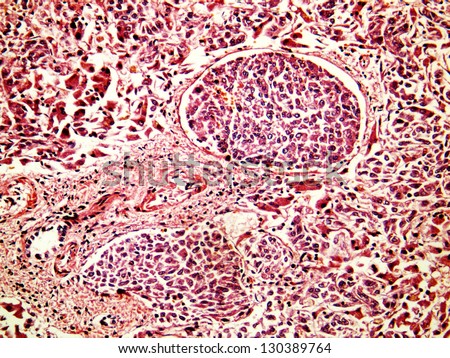 Hepatocellular cancer of liver of a human, metastasises in vessels, photomicrograph panorama as seen under the microscope, 200x zoom.