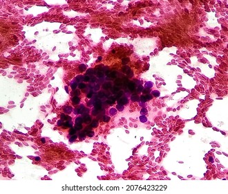 Hepatocellular Carcinoma, Cancer Cells Of Liver Surrounded By Red Blood Cells (RBC). Light Micrograph. FNAC Liver Solution Slide Hematoxylin And Eosin Stained Microscopic Zoom Image