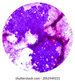 Hepatocellular Dysplasia, Cellular Enlargement, Nuclear Pleomorphism, And Multinucleation, Light Micrograph, Photo Under Microscope