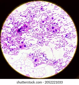 Hepatocellular Dysplasia, Cellular Enlargement, Nuclear Pleomorphism, And Multinucleation, Light Micrograph, Photo Under Microscope