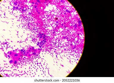 Hepatocellular Dysplasia, Cellular Enlargement, Nuclear Pleomorphism, And Multinucleation, Light Micrograph, Photo Under Microscope