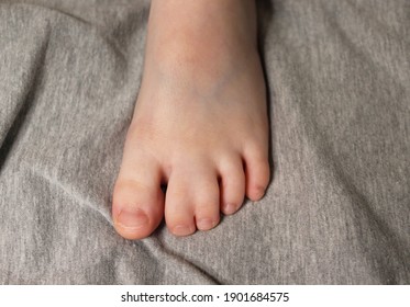 Hereditary Disease. Syndactyly. Child's Foot With Disease Close Up.