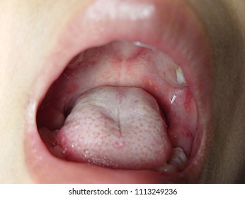Ulcer herpangina Herpangina causes,