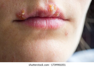 Herpes disease on the lips of a young girl. Wounds from herpes on the lips of a person. Herpes foci.