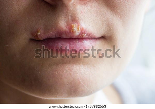 Herpes Disease On Lips Young Girl库存照片1737982553 Shutterstock 