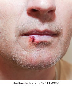 Herpes infection on the lips. Wound with blood on man's face. Medical care photo.