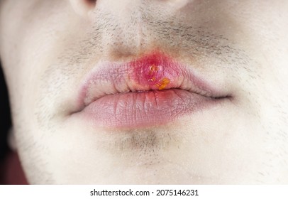 Herpes Labialis On The Lip Of A Caucasian Man. Face Close-up.
Сold Sores Illness Disease. Simplex Virus.