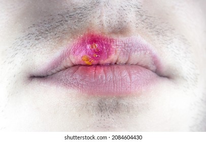 Herpes Labialis On The Lip Of A Caucasian Man. Face Close-up.
Сold Sores Illness Disease. Simplex Virus.