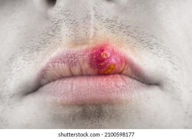 Herpes Labialis On The Lip Of A Caucasian Man. Face Close-up.
Сold Sores Illness Disease. Simplex Virus.