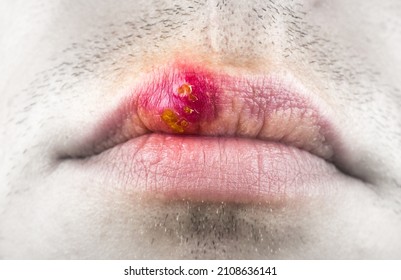 Herpes Labialis On The Lip Of A Caucasian Man. Face Close-up.
Сold Sores Illness Disease. Simplex Virus.