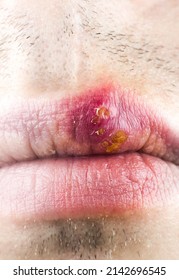 Herpes Labialis On The Lip Of A Caucasian Man. Face Close-up.
Сold Sores Illness Disease. Simplex Virus.