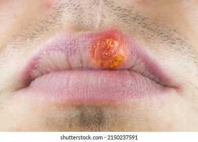 Herpes Labialis On The Lip Of A Caucasian Man. Face Close-up.
Сold Sores Illness Disease. Simplex Virus.