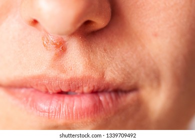 Herpes On Face Under Nose Girl Stock Photo (Edit Now) 1339709492