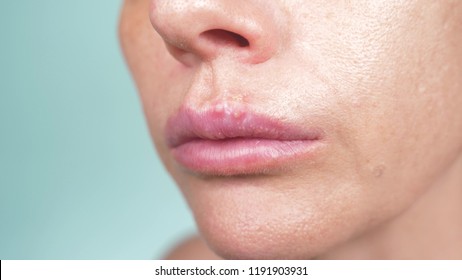 Herpes On The Female Lips. Close-up, Blue Background, Blur