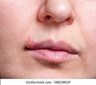 pictures of facial herpes Pictures of facial herpes