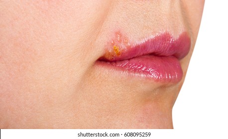 Herpes On Lip Close Macro Stock Photo 608095259 | Shutterstock