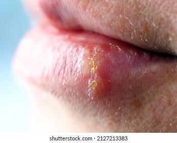 Herpes On Lip Woman Stock Photo 2127213383 | Shutterstock