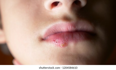 Herpes On Lips Boy Herpes Lip Stock Photo (edit Now) 1204584610