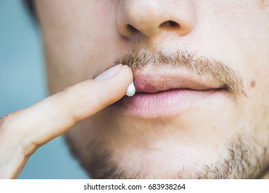 Herpes On Lips Of The Young Man. Man Smears Herpes With Herpes Cream.