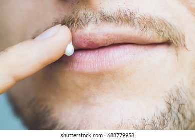 Herpes On Lips Of The Young Man. Man Smears Herpes With Herpes Cream.