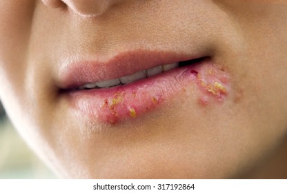 Herpes on a woman images