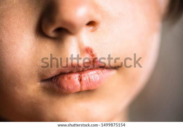 herpes Zoznamka miesto Nanaimo