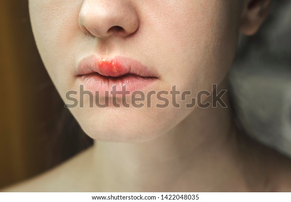 Herpes on the Upper Lip of a Young Woman. Medical\
Background of a Young Beautiful Girl with Herpes Labialis. Herpes\
Simplex Virus