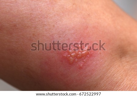 Herpes simplex on arm