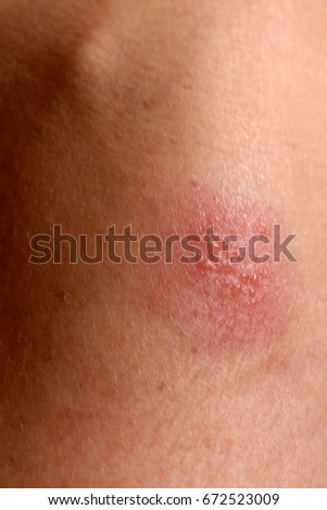 Herpes Simplex On Arm Stock Photo Edit Now 672523009 Shutterstock