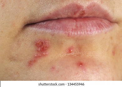 Herpes Simplex On Human Skin